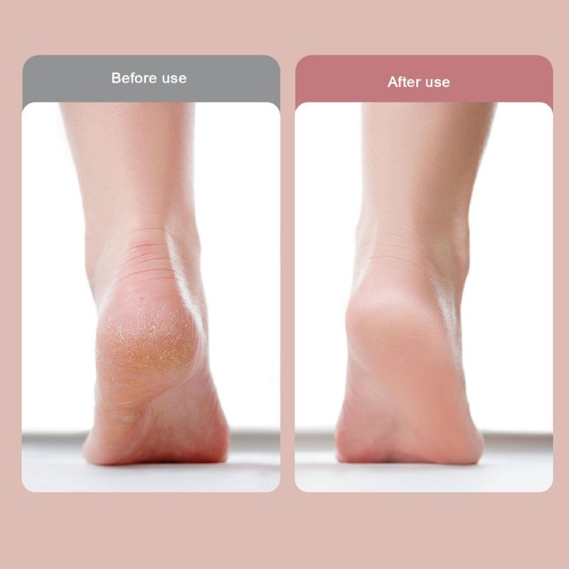 REMOVEDOR DE CALLOS ELECTRICO Y EXFOLIADOR DE PIES PARA PEDICURA PROFESIONAL